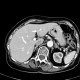 Renal cell carcinoma, multiphase CT, corticomedullary phase: CT - Computed tomography